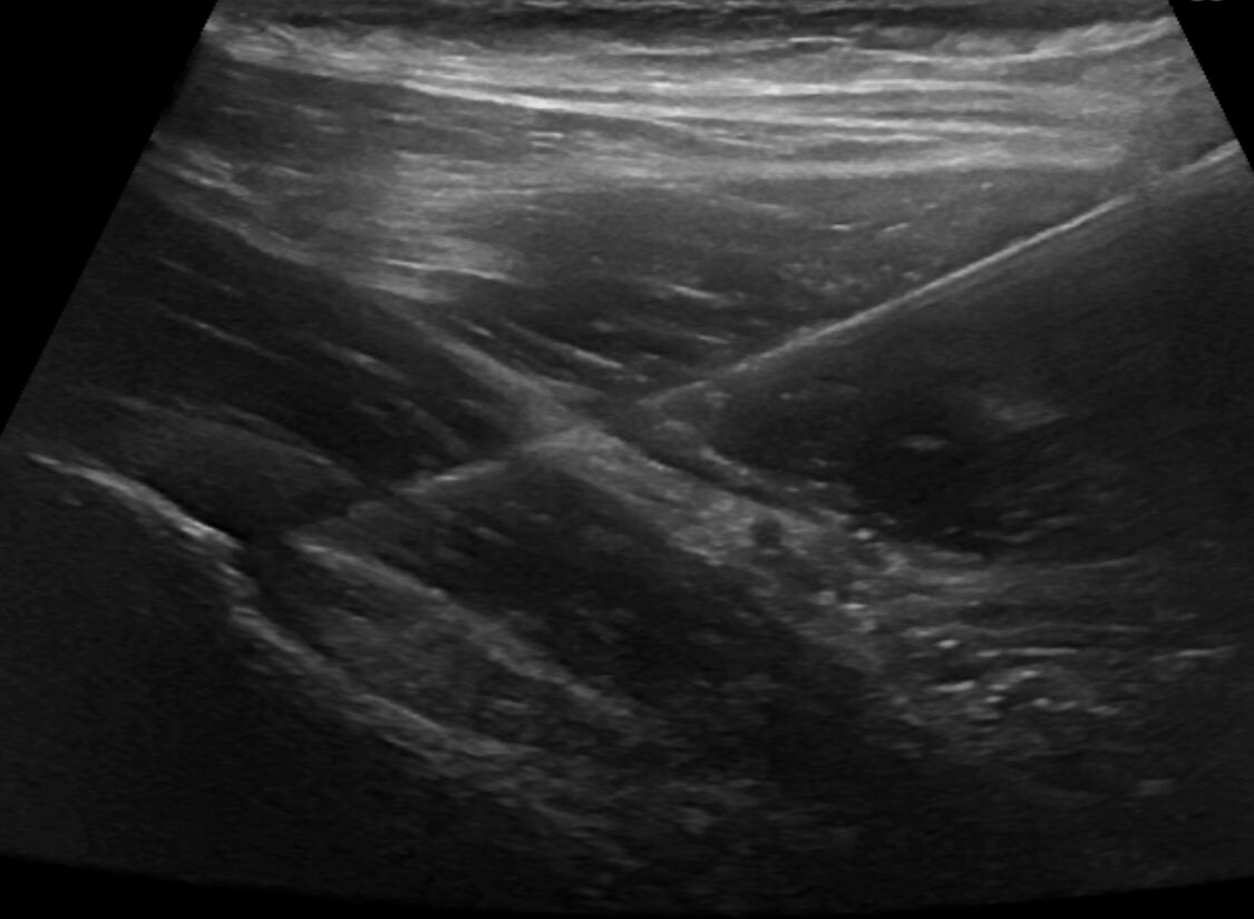 Hip joint injection (ultrasound guided)