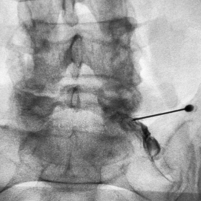 Transforaminal epidural nerve root injection