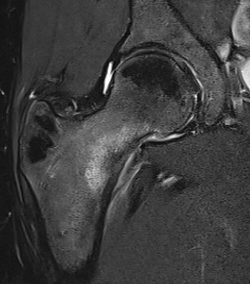 Hip stress fracture in runner (MRI)