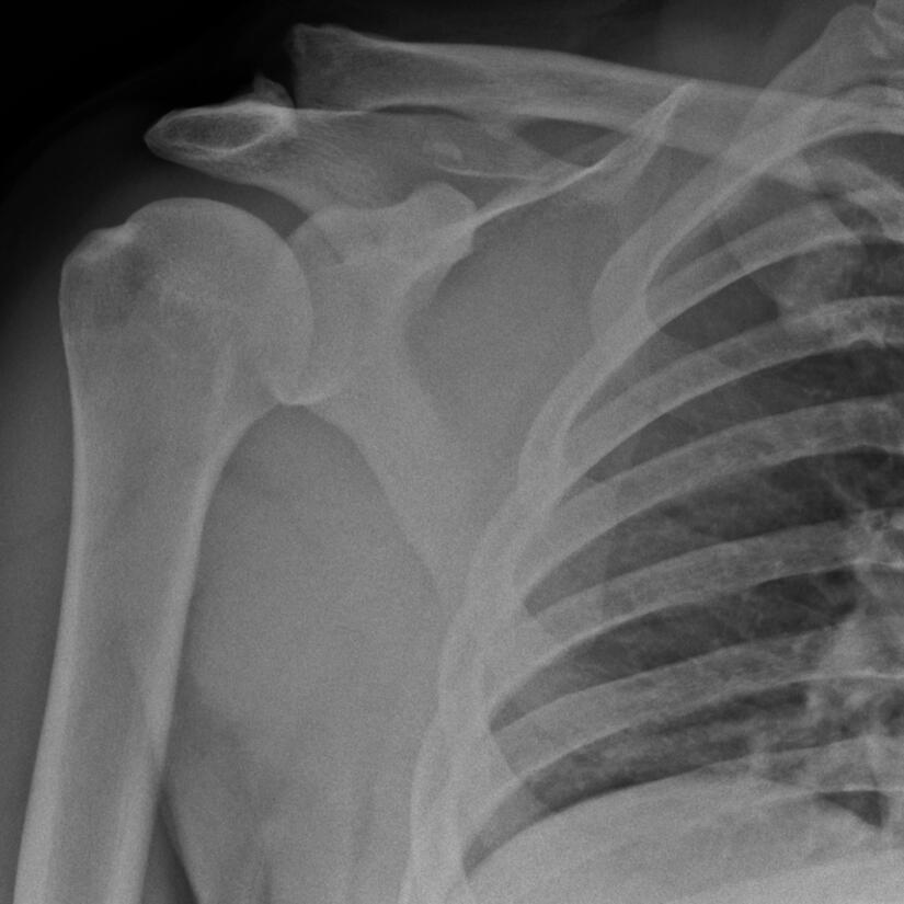 Traumatic AC joint dislocation (X-ray)