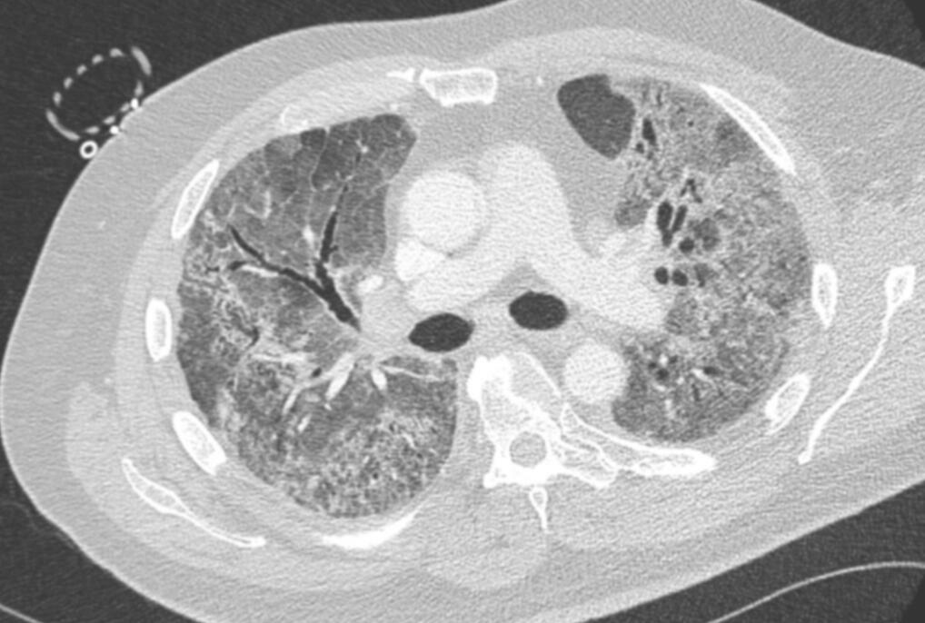 Lungs appearances after COVID-19 (High resolution CT scan)