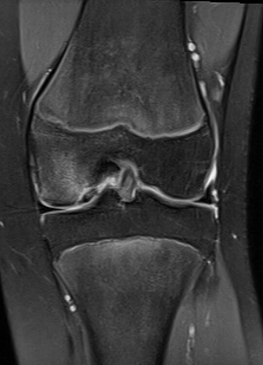 Adolescent osteochondral injury (MRI)