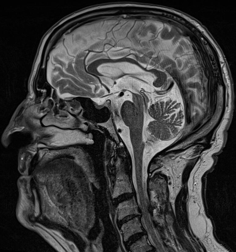 Progressive supranuclear palsy (MRI)