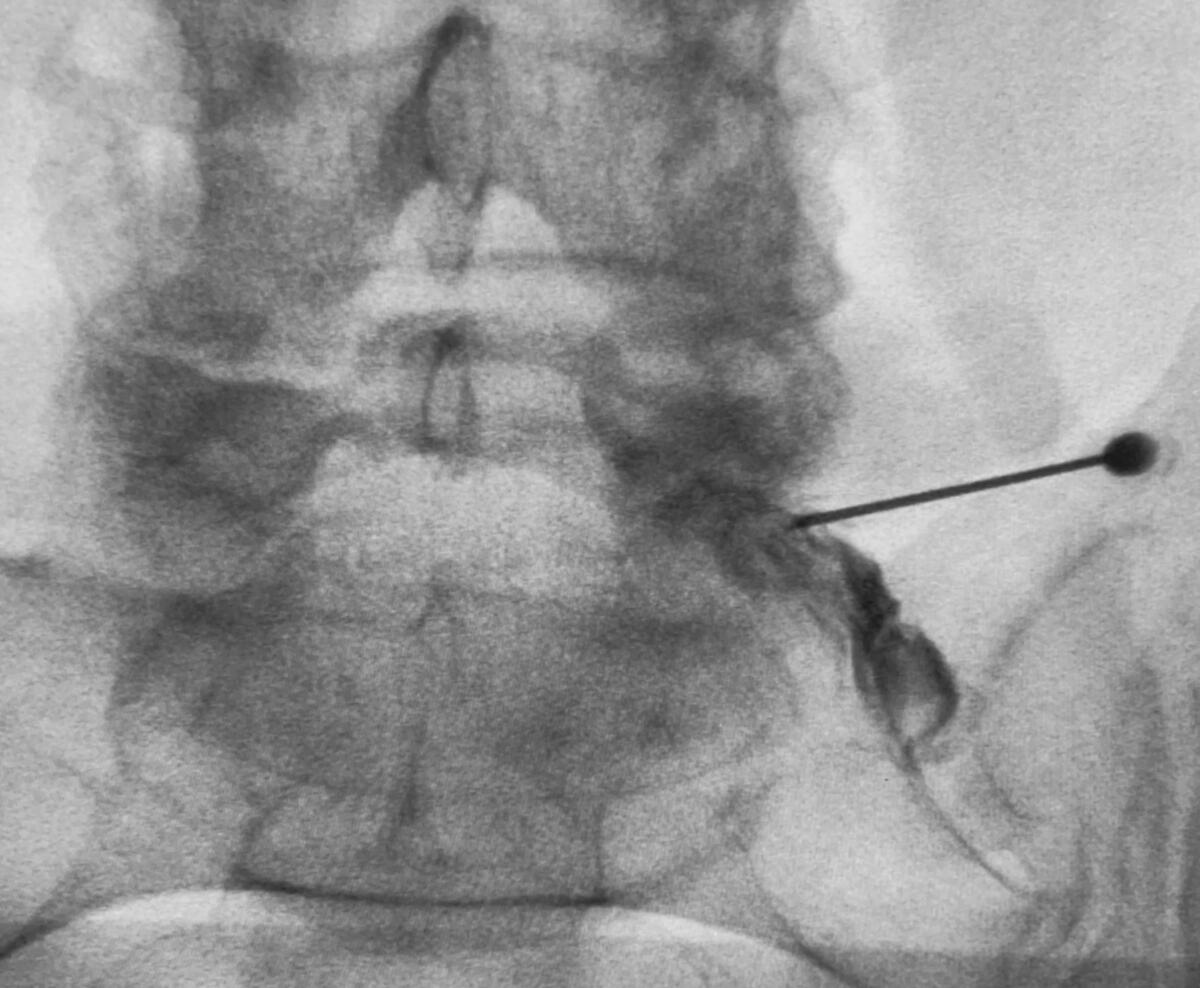 Spinal epidural facet injection in Leeds, Harrogate and York